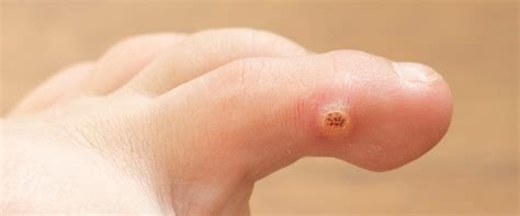 Plantar Wart Root Removal Surgery | Bruin Blog