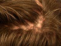 Scarring Alopecia, Advice and Treatment Avoid Antibiotics