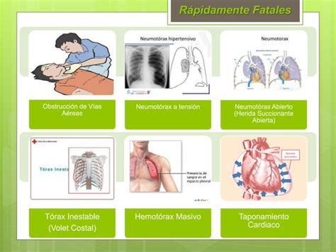 Protocolo De Traumatismo Toracico Hospitalario Ppt Descarga Gratuita