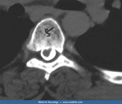 Arachnoid Cyst Medlink Neurology