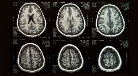 Fases Do Desenvolvimento Cerebral Braincp