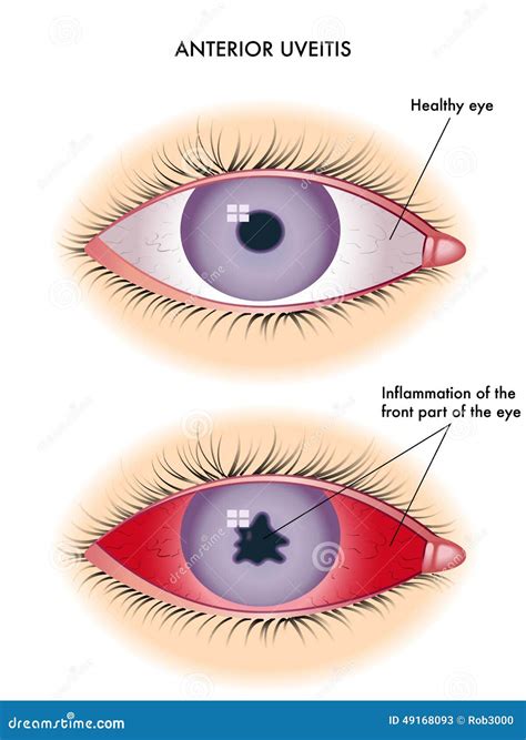 Uveitis Clipart And Illustrations