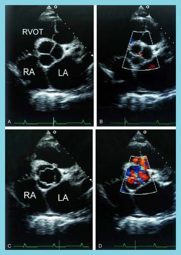 Parasternal Short Axis Interrogationcolor Doppler Of The Aortic Valve