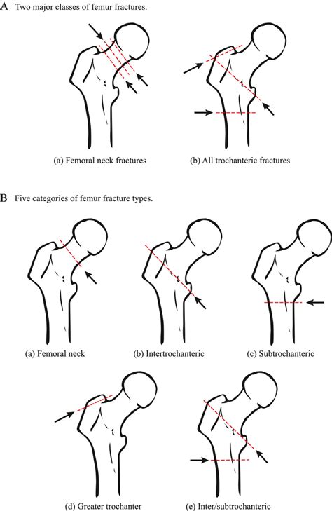 Femur Fracture Classification