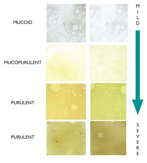 Chest Mucus Color Chart