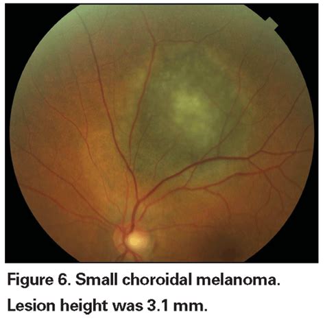 Nevus Or Melanoma How To Differentiate