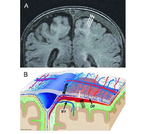 MR Image And Graphic Representation Of Subdural Hematoma Panel A T1W