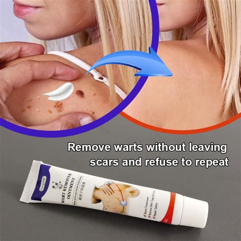 Pcs Warts Remover Antibacterial Ointment Wart Treatment Cream Skin Tag