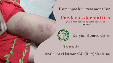 Paederus Dermatitis Treatment In Homeopathy By Dr Ch Ravi Kumar M D Hom Medicine Kalyan Homoeo