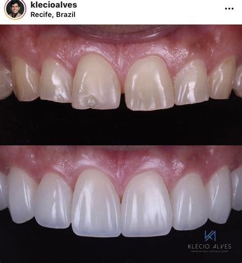 Before And After Porcelain Veneers From Doctor Klecioalves The Top