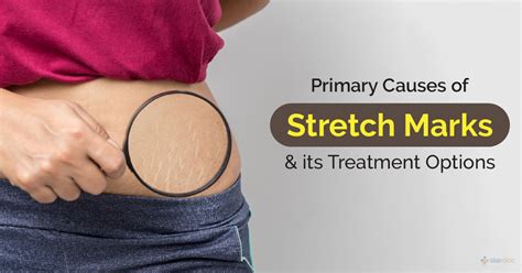 Stretch Marks Symptoms Treatment Causes And Diagnosis