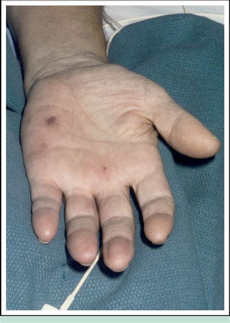 Figure 3 From Osler S Nodes And Janeway Lesions Semantic Scholar