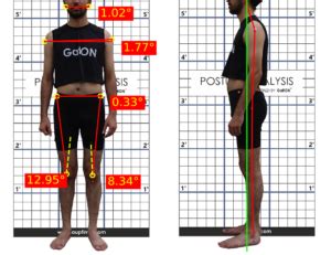 GaitON An Easy To Use Posture Analysis System With Clinical Accuracy