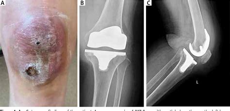 Figure 1 From Primary Cutaneous Diffuse Large B Cell Lymphoma After