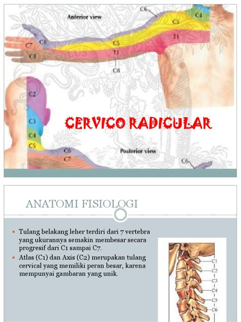 Radikulopati | PDF