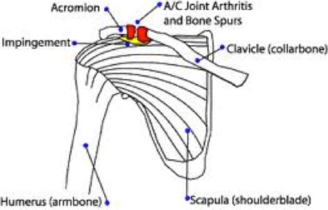 AC joint arthritis - Knee, Hip and Shoulder