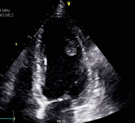 Anticoagulation Guidelines For Lv Thrombus | semashow.com