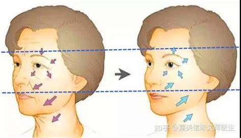 中面部衰老的表现和治疗方法 知乎