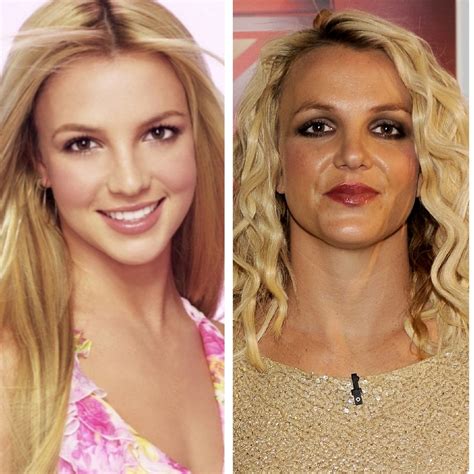 Britney Spears Before and After Cosmetic Surgery - Verge Campus