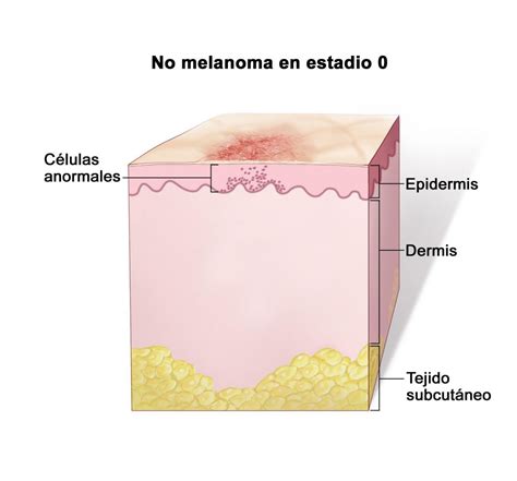 Qu Es Y Como Tratar El Melanoma Maligno El Titular