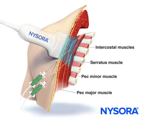 Fascial Plane Blocks Understanding Their Microanatomy And Clinical