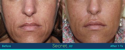 Secret Rf Micro Needling Genuineu Md