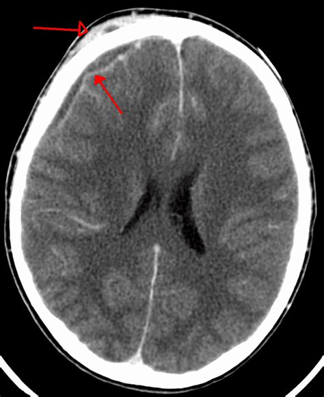 Intracranial Infections Teachmesurgery