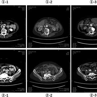 Enhanced Computed Tomography Ct Revealed An Abdominal Aorta In