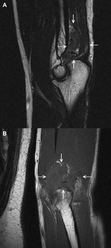 Sagittal Mr Images A A Fast Spin Echo T Weighted Mr Image Showed A