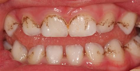 Black Stains On The Teeth Major Causes And Best Solutions MD Health