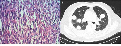 Figure 2 From Stewart Treves Syndrome As A Rare And Fatal Complication