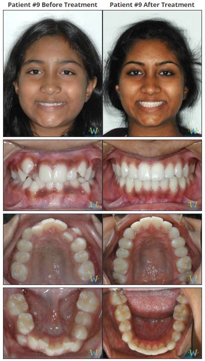 Teeth Before And After Braces Crowding