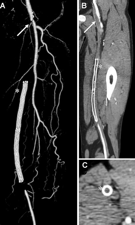 Stent Puncture For Recanalization Of Occluded Superficial Femoral