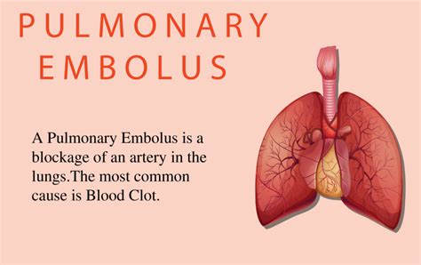 Pulmonary Embolism Explained Causes Symptoms And Treatment NBKomputer