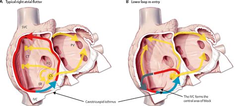 Catheter Ablation Of Atrial Arrhythmias State Of The Art The Lancet