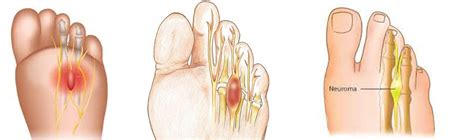 Podiatrists In Chicago Treat Neuromas