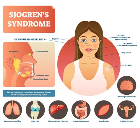 Sjogren Syndrom Ss Symptome Therapie Selbsthilfe Autoimmun