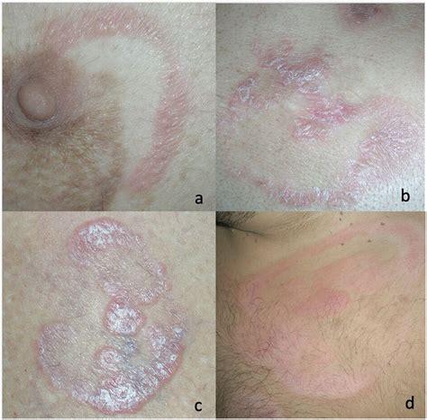 Annular Skin Tumors And Lymphoproliferative Diseases Clinics In