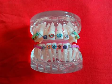 Frete Gr Tis Branco Transparente Dente Dental Ortodontistas Modelo