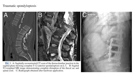 Oren Gottfried Md On Twitter I Wish We Restored Spinal Cord Function