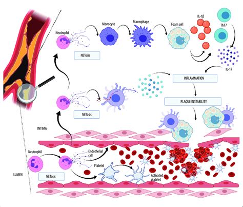 The Role Of Neutrophil Extracellular Trap Formation Netosis In The