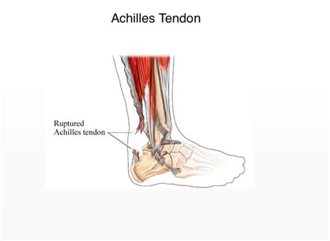 Calcaneal tendon rupture. Achilles Tendon Rupture: Causes, Symptoms ...