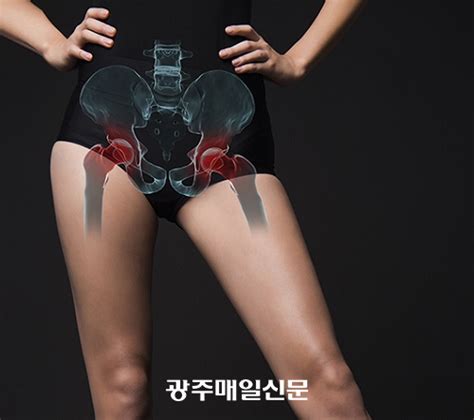 고관절통증 동반하는 골반 틀어짐 치료 시야 넓혀야 광주매일신문