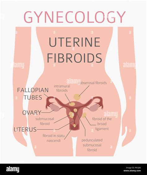 Uterine Fibroids Ginecological Medical Desease In Women Infographic