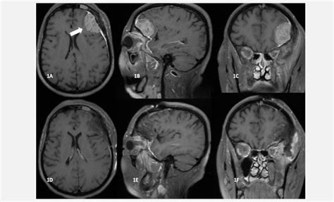 Mri 1a In Contrast Enhanced T1 Weighted Sequence Axial Image Lesion Download Scientific