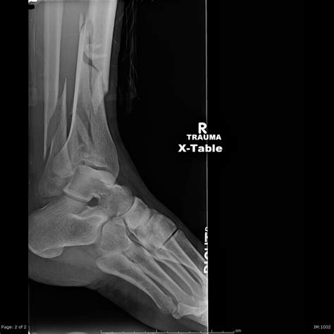 Tibial Plafond Fractures Trauma Orthobullets