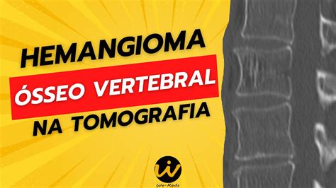 Hemangioma ósseo vertebral na tomografia computadorizada TC de coluna