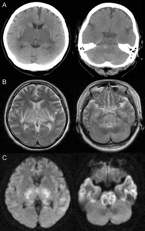 Clinical Imaging A CT Showed Low Density Area In The Bilateral