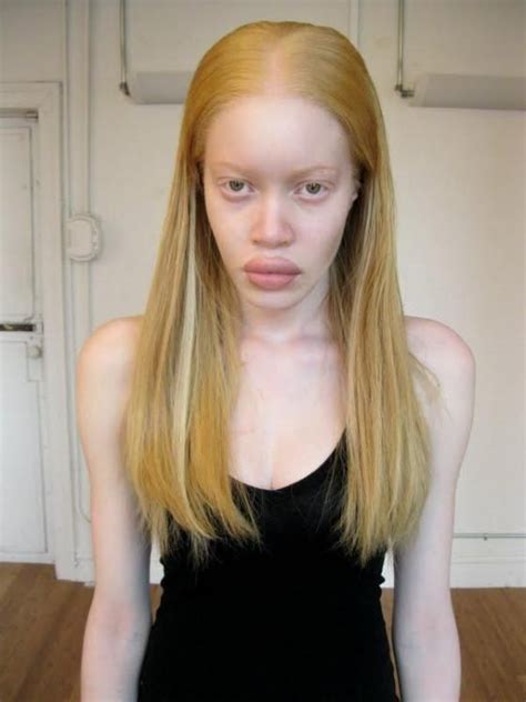 Pin Su Portrait Albinism