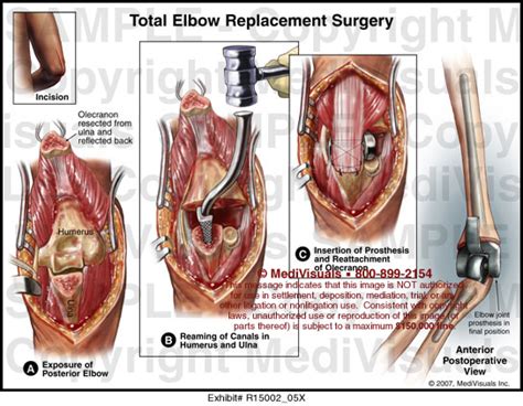 Total Elbow Replacement Surgery MediVisuals Medical Illustration